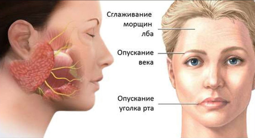 Неврит лицевого нерва