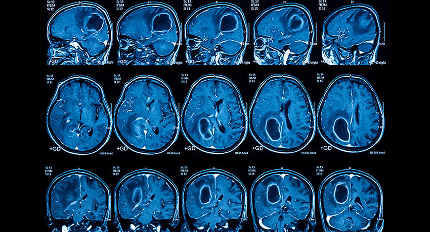 Снимки головного мозга при МРТ