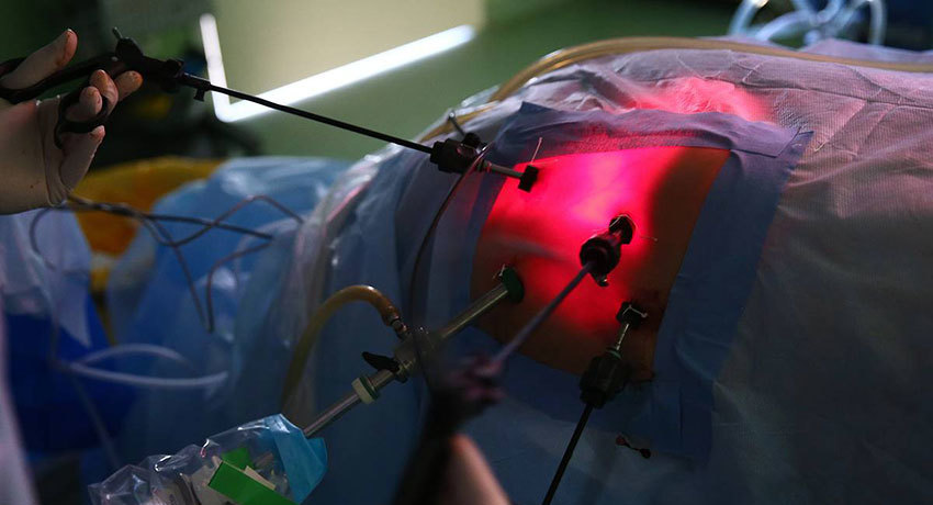 Паллиативная хирургия в сочетании с интраоперационной фотодинамической терапией у больных раком желудка