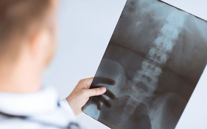 Cervical Herniated Disc Causes and Diagnosis