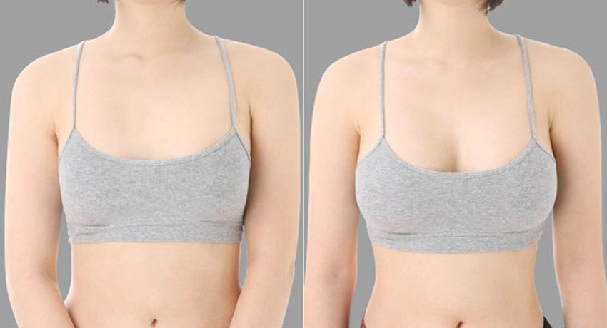 Увеличение груди: до и после